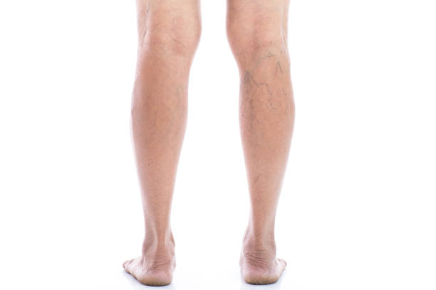 Varicose Veins